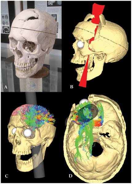 The skull of Phineas Gage alongside digital recreations of his injuries