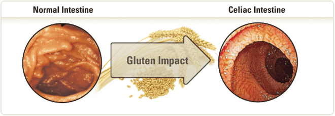 Normal Intestine vs. Celiac Intestine (caused by immune response triggered by gluten in susceptible individuals)