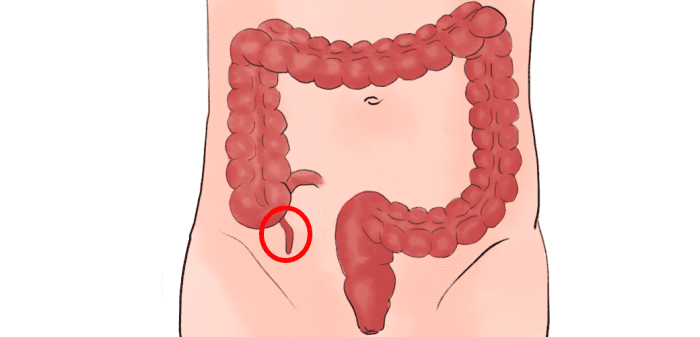 Appendicitis is an inflamed appendix and can cause abdominal tenderness among other symptoms.