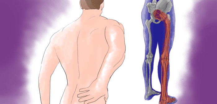 When a herniated disc puts pressure on the sciatic nerve there may be pain in the back and numbness in the buttocks, legs, or feet.