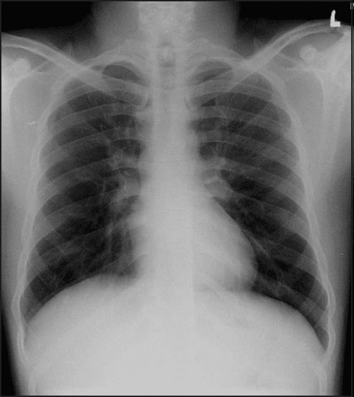 Gas exchange occurs in the alveolus where capillary blood flow and inspired air are separated only by thin wall composed mainly of type 1 pneumocytes and capillary endothelial cells and the capillary and alveolar basement membranes are fused as one.