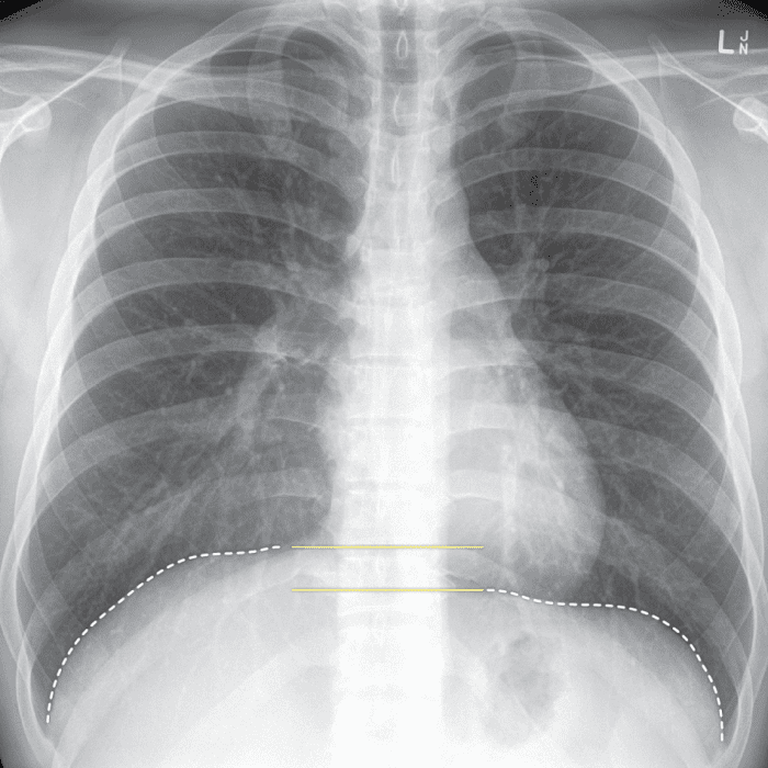 Within the Lungs and Bronchi branch again, forming secondary and tertiary bronchi, then smaller bronchioles and finally terminal bronchioles ending at the alveoli.