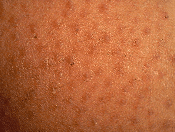 Keratosis Pilaris Pictures Symptoms Causes Treatment Hubpages 