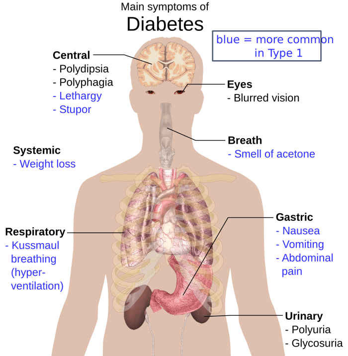 Polydipsia is excessive thirst. Polyphagia is excessive hunger. The breath may smell like juicy-fruit gum.