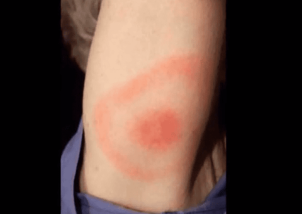 The area around the bite can have a red bullseye appearance or it can have a blueish, bruised appearance.