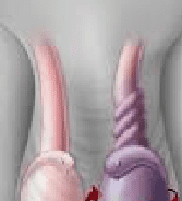 An Illustration Showing Testicular Torsion On The Right And A Normal Spermatic Cord On The Left.