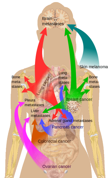 Main sites of metastases for some common cancers.Primary cancers are denoted by "...cancer" and their main metastasis sites are denoted by "...metastases".