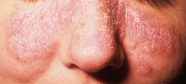 Lupus Rash – Pictures, Symptoms, Causes, Treatment - HubPages