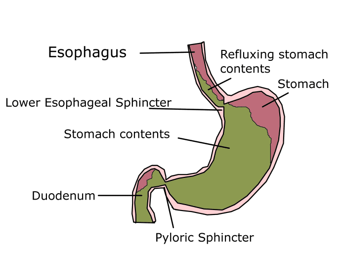 Progesterone causes the lower esophageal sphincter to relax, allowing stomach contents to reflux into the esophagus.