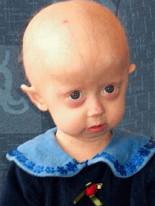 This child has been diagnosed with Progeria.