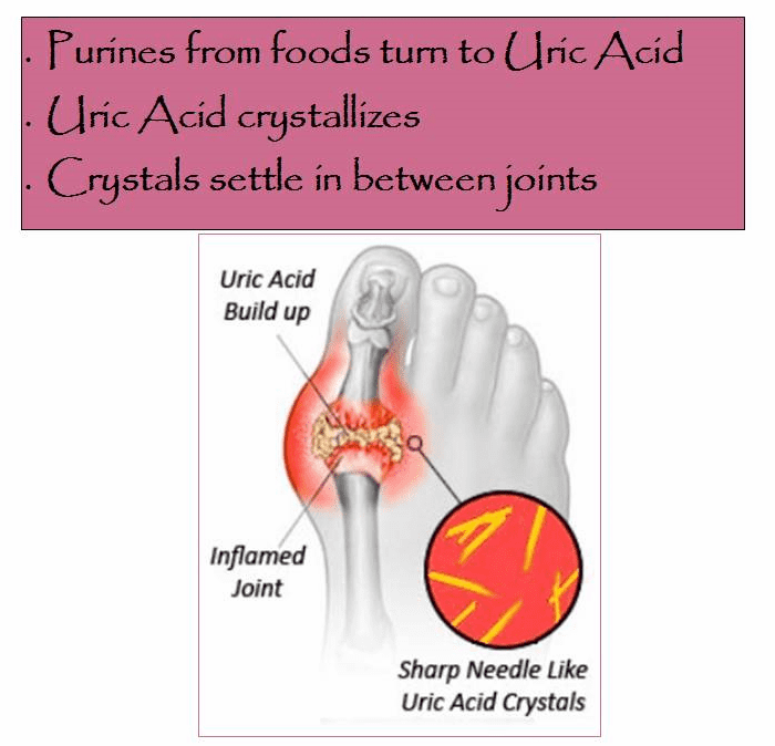Everything You Ever Wanted to Know About Gout: Causes, Symptoms ...