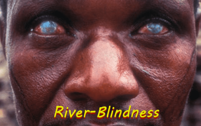 River Blindness is a horrible disease that causes blindness after being infected the parasitic worm called Onchocerca Volvulus.