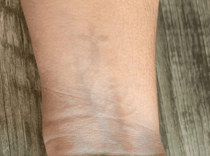 As mentioned, I did not finish the treatment and like the faded look. This photo is after 11 total treatments and 2 years post laser treatment of any kind.