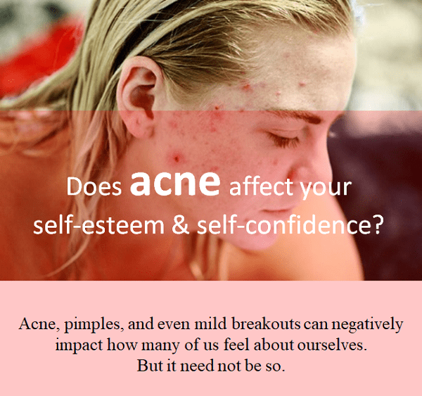 Acne And Self Rejection Does Acne Affect Your Self Esteem Remedygrove 2740