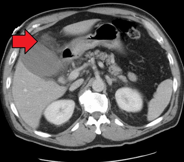 Acute cholecystitis as seen on CT. Note the fat stranding around the enlarged gallbladder.