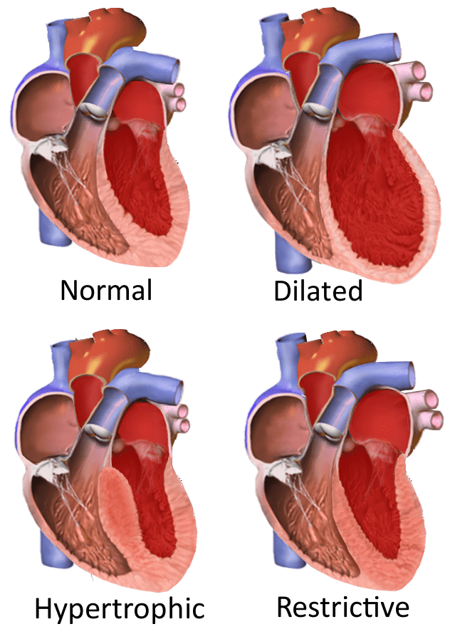 Cardiomyopathy Meaning In Tagalog