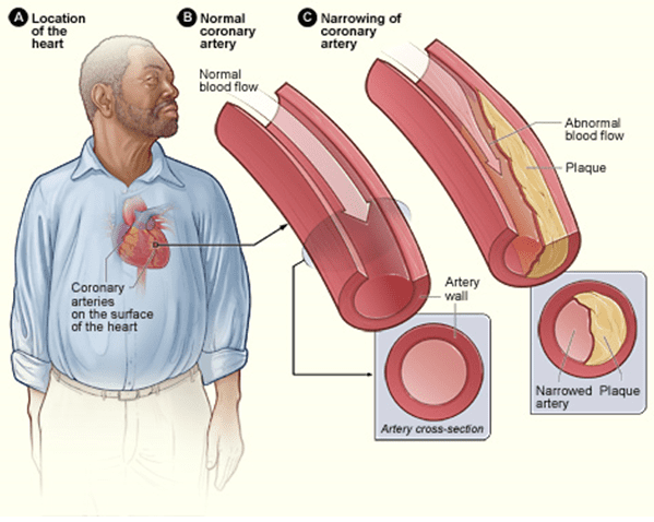 Coronary Heart Disease, Atherosclerosis