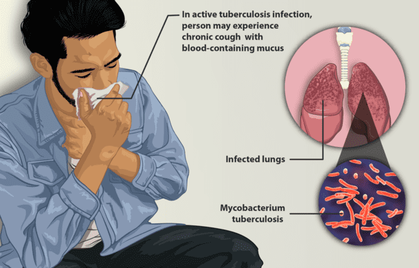 Tuberculosis (TB) - a Serious Infection - HubPages