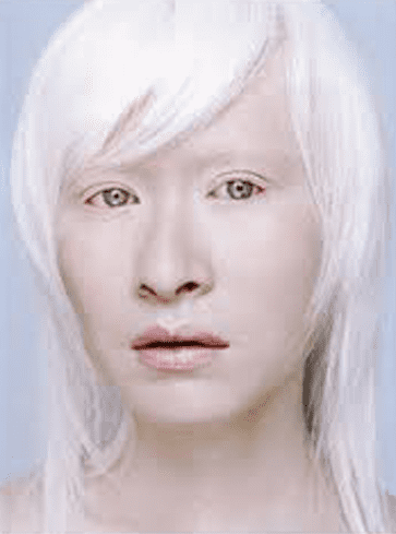 Albinism as it is called when it effects humans is considered a inherited condition with much stigmatization.