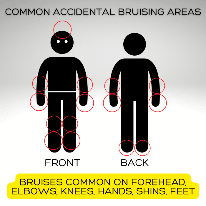 These are areas of normal, accidental bruising on a child. Bruises in these areas are common in children and are less indicative of abuse.