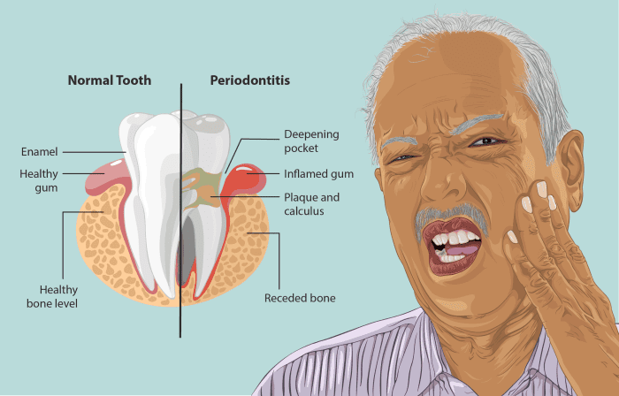 gums-peeling-how-to-fix-them-before-it-s-too-late-youmemindbody