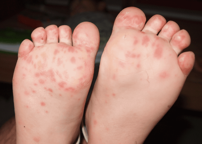 7 Possible Causes Of Red Dots On Feet YouMeMindBody