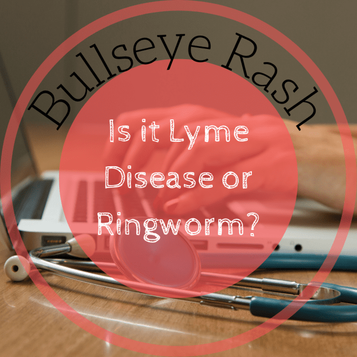 Bullseye Rashes Ringworm And Lyme Disease Differences And My Diagnosis 2022 8947