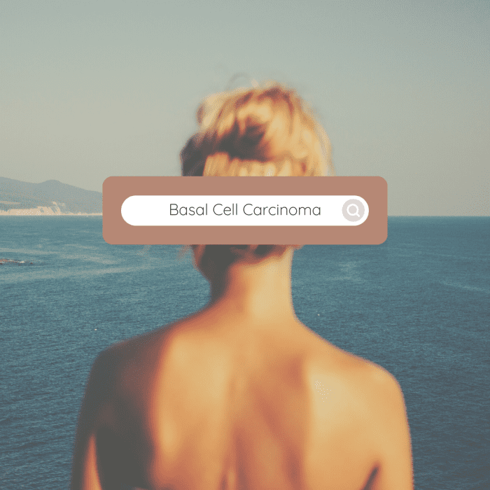 Basal cell carcinoma is the most common form of skin cancer. It can cause the destruction of the surrounding tissue. It is most important to have it diagnosed early so it can be treated.