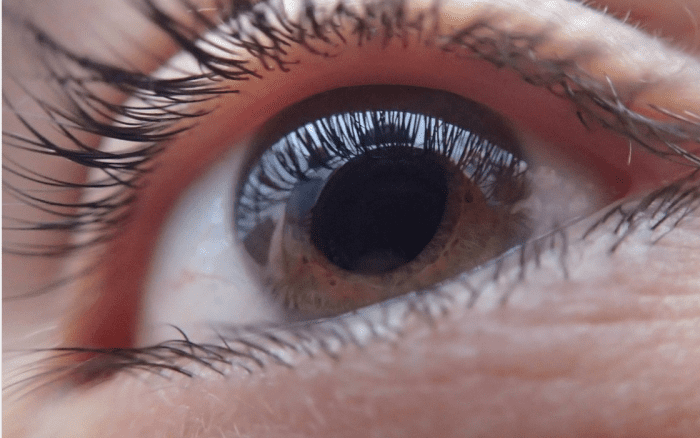 can-you-get-side-effects-from-eye-dilation-youmemindbody