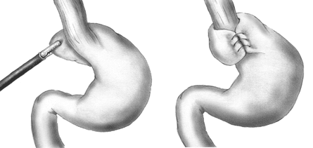 A Nissen Fundoplication wraps the fundus of the stomach around the esophagus to physically prevent food and stomach acid from refluxing.