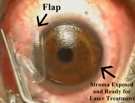 This is a still image from a LASIK procedure in which I assisted the ophthalmologist. You can clearly see the flap and the underlying stromal bed ready to be treated with laser.