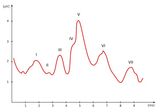 An ABR reading: the presence of Wave V (wave five) activity indicates the sound was heard. If the sound was not heard, the wave V would be flat.