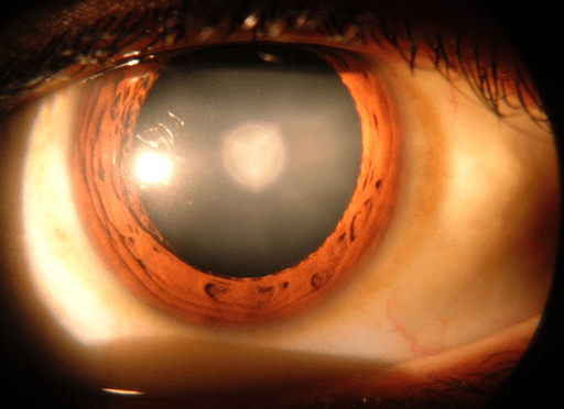 What does a cataract look like?