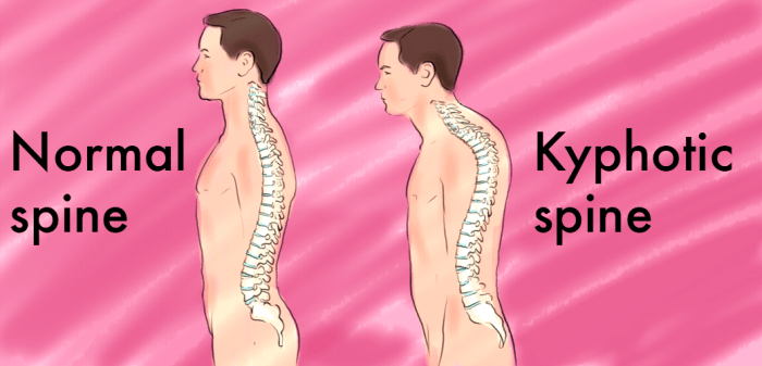 There are normal curves in the neck, mid back, and lower back. When the curve of the upper back is accentuated, it is known as a kyphotic spine, as shown in the right picture.