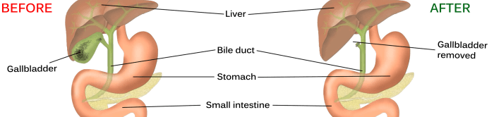 diet-after-gallbladder-removal-surgery-youmemindbody-health-wellness