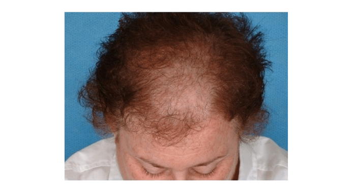 Androgenetic Alopecia