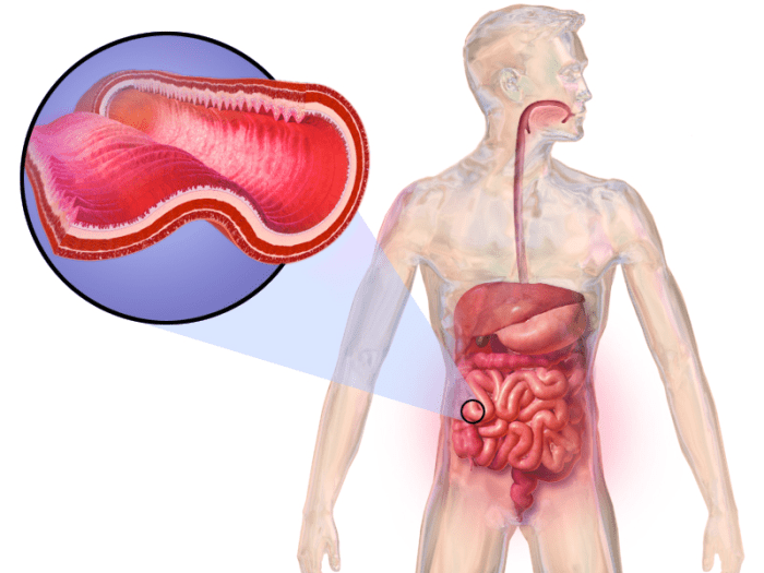 who-is-most-susceptible-to-having-crohns-or-ulcerative-colitis