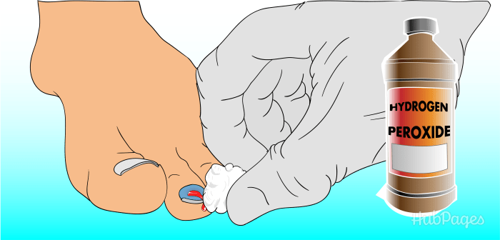 Use peroxide to keep the blood from clotting in the hole so that blood can continue to drain over the next few days.