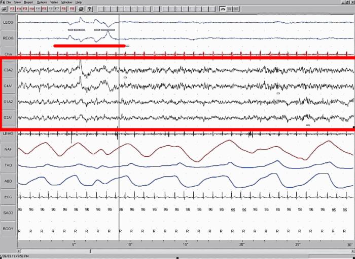REM sleep demonstrates an increase of brain activity (similar to wakefulness), while the body remains immobilized.