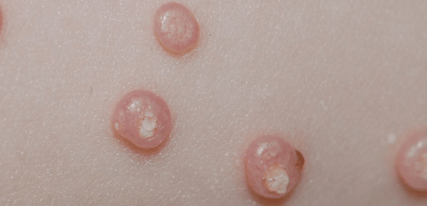 Molluscum Contagiosum: Smooth, round bumps of varying size, with a central indentation, firm to the touch, and filled with a waxy substance.