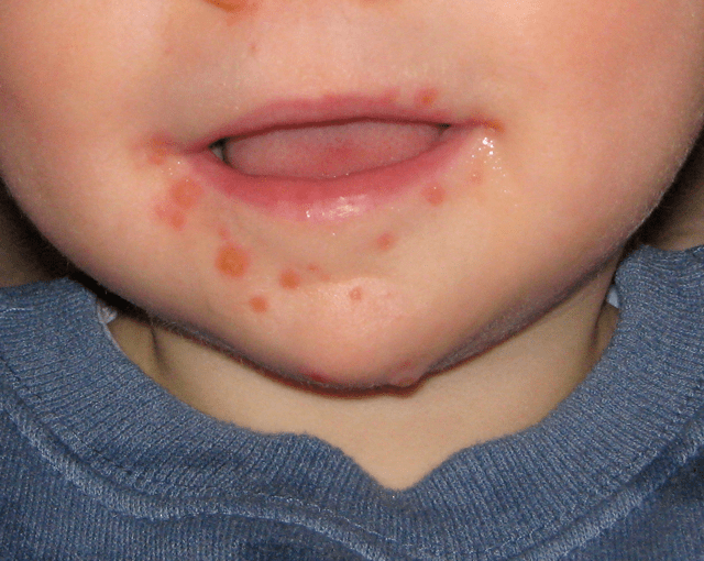 These lesions are caused by hand, foot, and mouth disease in an 11-month-old male.