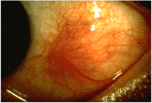 Scleritis is an inflammation of the sclera, or whites of the eyes. The sclera is the tough membrane that forms the outer wall of your eyeball.