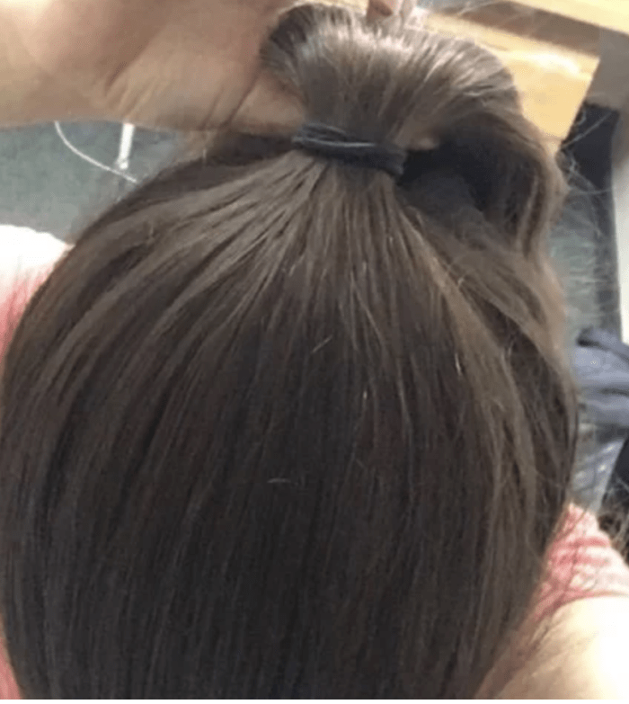 My hair now, 4 years after stopping Accutane. Nearly 100% of its density has recovered, and I am so delighted and blessed.