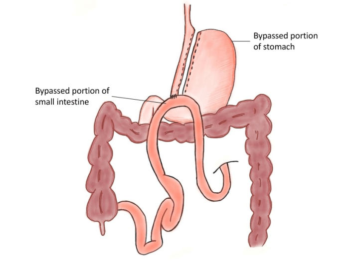 Diagram of a mini-gastric bypass, also known as a single-anastomosis bypass or an omega loop gastric bypass.