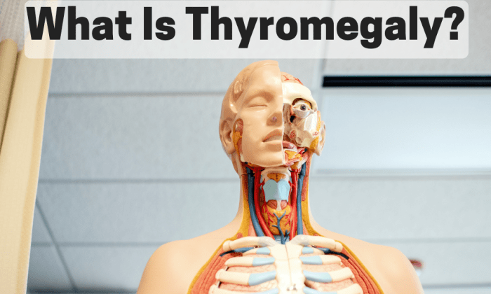 Thyromegaly, also known as goiter, is the enlargement of the thyroid gland and it can cause series health complications.