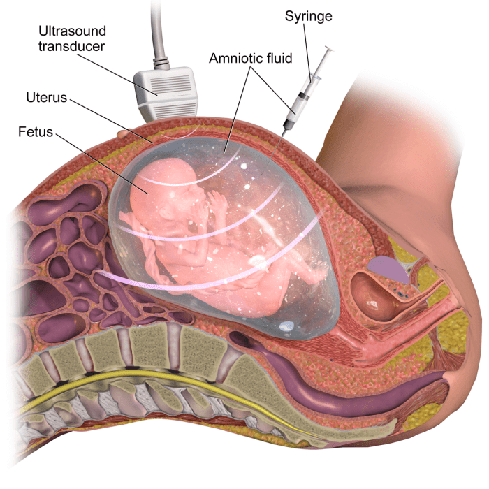 Amniotic fluid is withdrawn using a needle. The fetal genetic material is isolated and tested, providing diagnostic information.