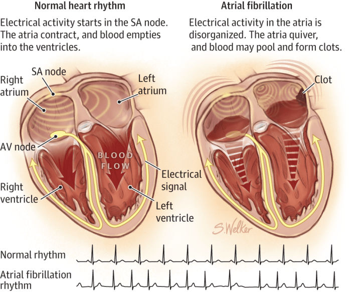 Atrial fibrillation occurs when the top two chambers (atria) beat irregularly (i.e. not in rhythm with the rest of the heart).