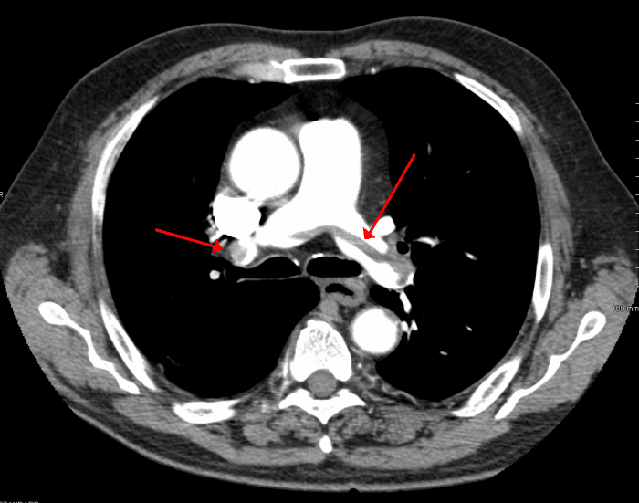 A CT scan showing pulmonary embolism.
