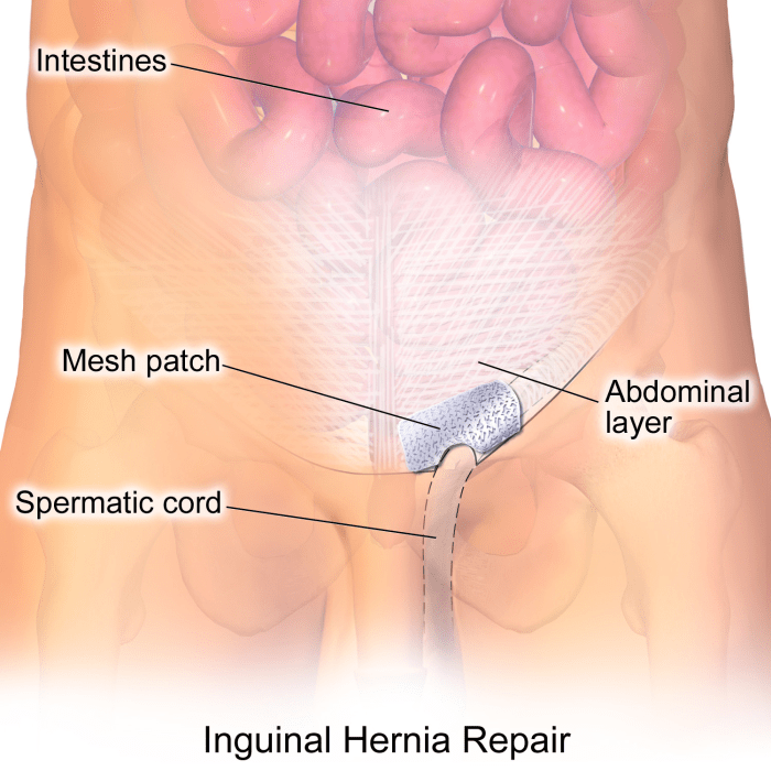 Hernias are usually fixed by putting the protruding tissue back in place and reinforcing the opening with a sterile mesh.