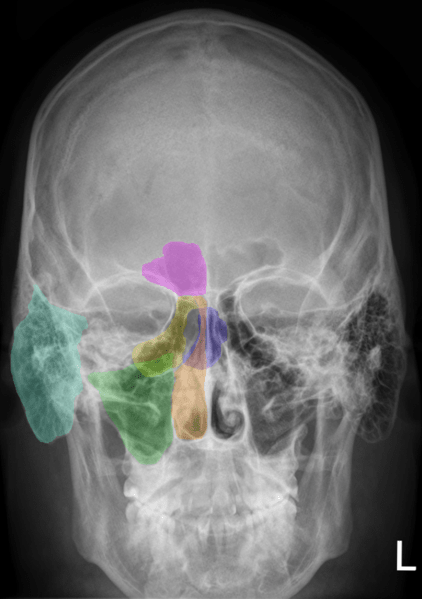 Sinuses, with right side color coded. Frontal sinus is purple, ethmoid yellow, sphenoid blue, and maxillary sinus in green. The aqua green to the far left is the mastoid cells.